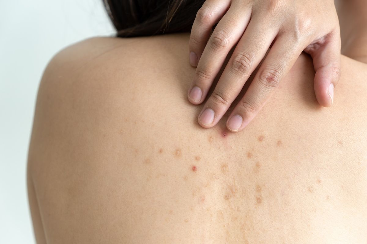 A woman runs her hand over dermatologic spots down her back 